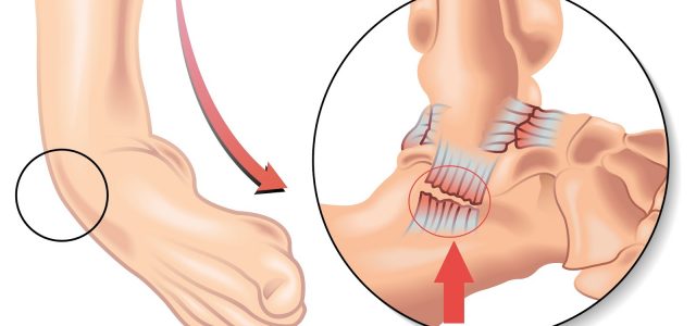 image entorse ligamentaire cheville